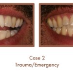 Before and After image of a dental emergency