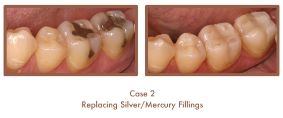 Before and After images of fillings