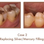 Before and After images of fillings