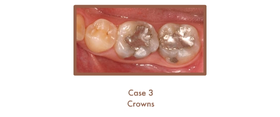 Before image of crowns