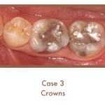 Before image of crowns
