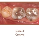 Before image of crowns