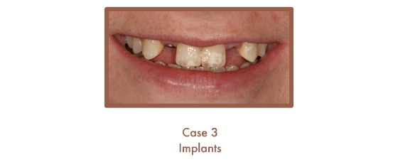 Before dental implants