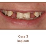 Before dental implants