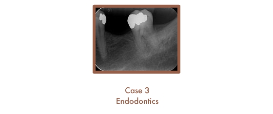 Endodontics Case Study
