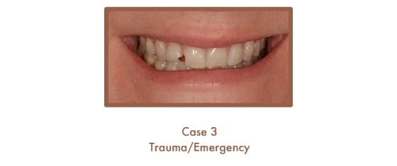 Before image of a dental emergency