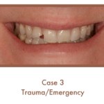Before image of a dental emergency