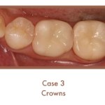 After image of crowns