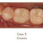 After image of crowns