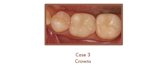 After image of crowns