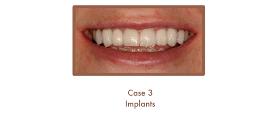 After dental implants