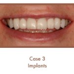 After dental implants
