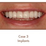 After dental implants