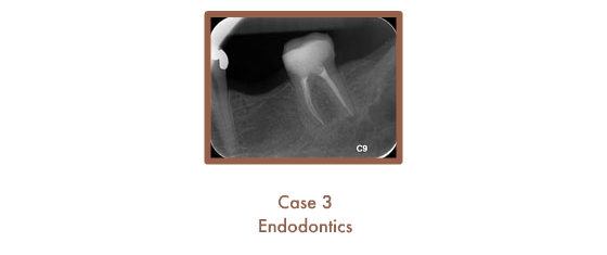 Endodontics Case Study