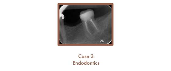 Endodontics Case Study