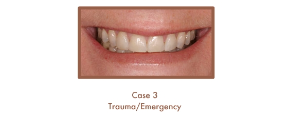 After image of a dental emergency