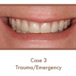 After image of a dental emergency