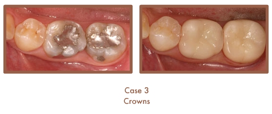 Before and after image of crowns