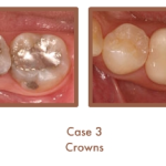 Before and after image of crowns