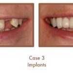 Dental implants case study image