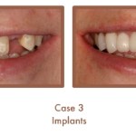 Dental implants case study image