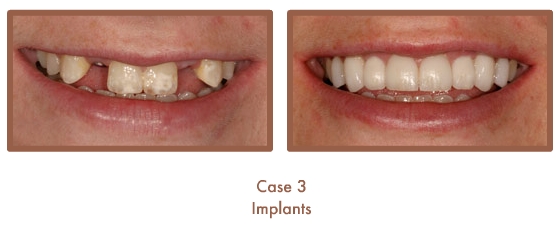 Dental implants case study image