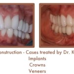Reconstruction Case Study