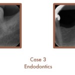 Endodontics Case Study