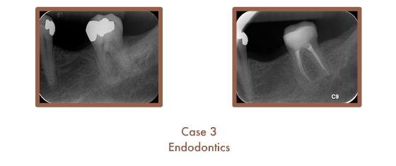Endodontics Case Study