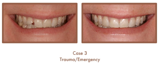 Before and After image of a dental emergency
