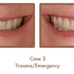 Before and After image of a dental emergency