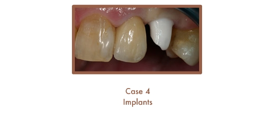 Before dental implants
