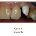 Before dental implants