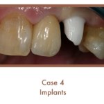 Before dental implants