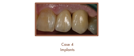 After dental implants