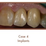 After dental implants
