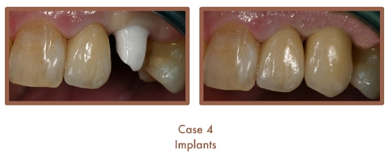Dental implants case study image