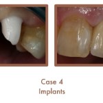 Dental implants case study image
