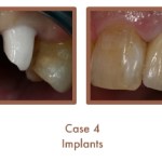 Dental implants case study image