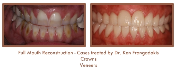 Reconstruction Case Study