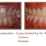 Reconstruction Case Study