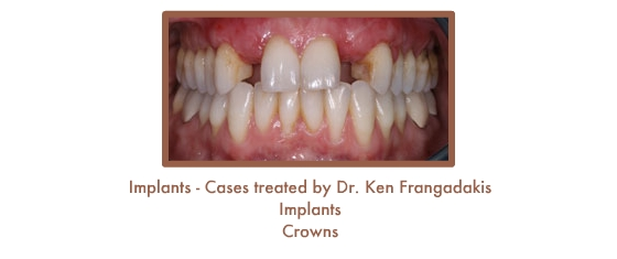 Before dental implants