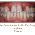 Before dental implants