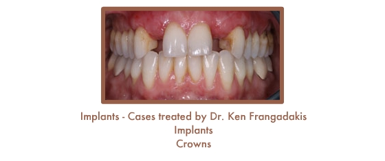 Before dental implants