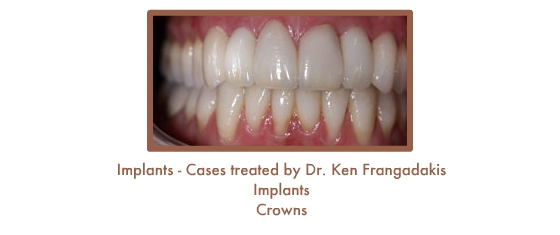 After dental implants