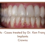 After dental implants