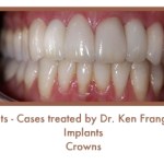 After dental implants