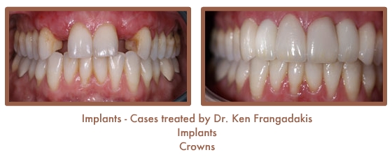 Dental implants case study image