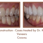 Reconstruction Case Study