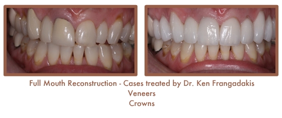Reconstruction Case Study